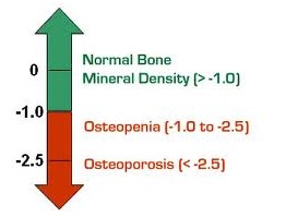 apa itu osteoporosis 2