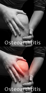 Osteoarthtritis